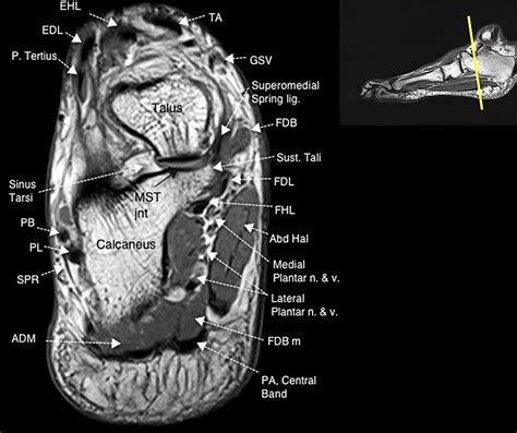 Normal Magnetic Resonance Imaging Anatomy of the Ankle & Foot - Magnetic Resonance Imaging Clinics