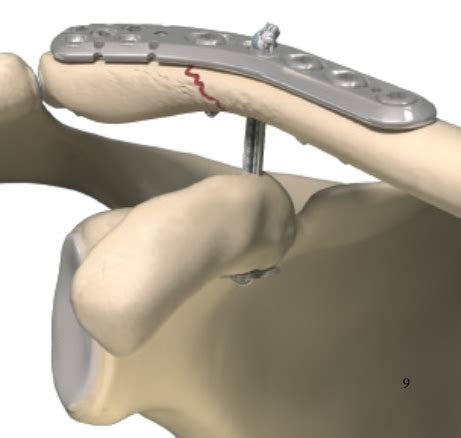 ORIF Clavicle