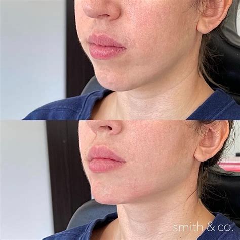 here we injected JUVÉDERM® VOLUMA XC to enhance her profile by bringing out her chin projection ...