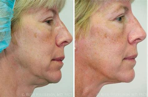 Thermage - Skin Tightening Photos | Richmond, VA | Patient 5021