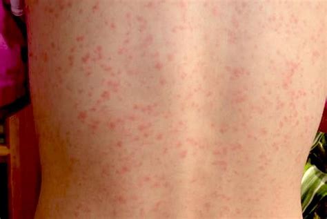 Scarlet fever: Causes, symptoms, treatment, and complications | Strep ...