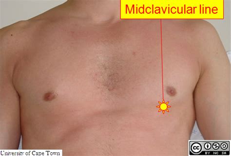 Midclavicular Line 5th Intercostal Space