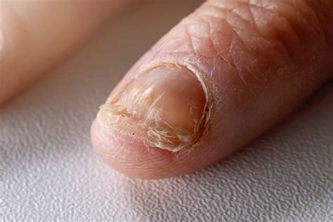 What Are the Causes of a Nail Bed Infection? | Spire Orthopaedic