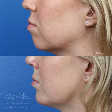 Double Chin Removal Surgery in New York - Philip Miller MD