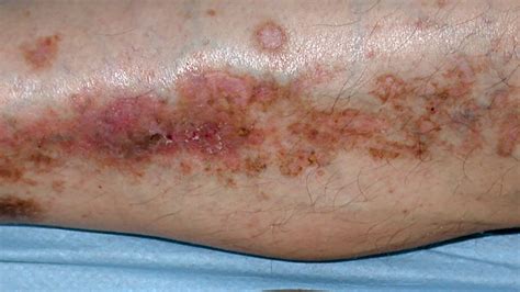 Skin Disease Due To Diabetes - DiabetesWalls