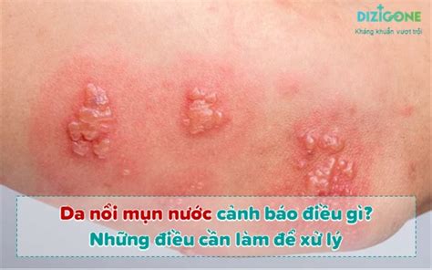 Da nổi mụn nước cảnh báo bệnh gì? Những điều cần làm để xử lý - Dizigone - Kháng khuẩn vượt trội