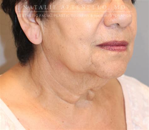 Beverly Hills Facelift Before and After Photos - Los Angeles Plastic ...