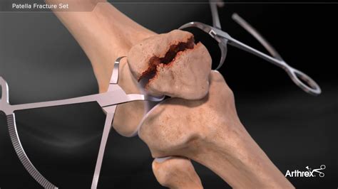 Arthrex - Patella Fracture