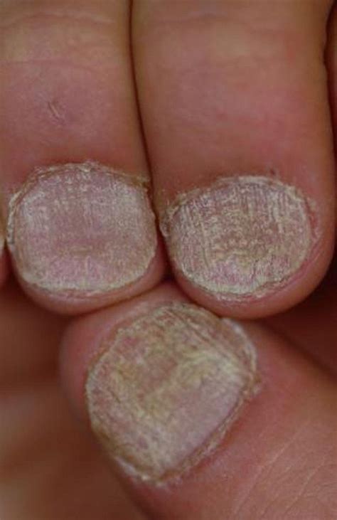 Nail Deformities and Dystrophies - Dermatologic Disorders - MSD Manual ...