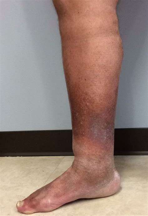 Venous Insufficiency Pictures Symptoms And Pictures - vrogue.co
