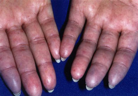 Scleroderma - Harvard Health