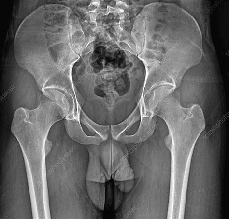 Male pelvis bones and joints, X-ray - Stock Image C033/7351 - Science Photo Library