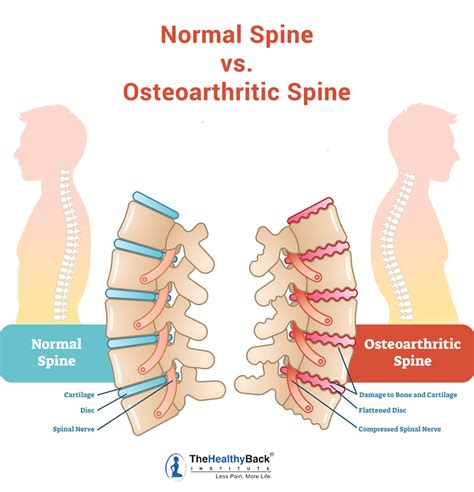 Spinal Arthritis: Causes, Symptoms and Treatments