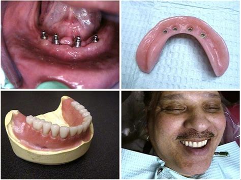 Implant Supported Mandibular O-Ring Attachment Overdenture System ...