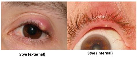 Swollen Eyelid - Know the causes, remedies and alert signs