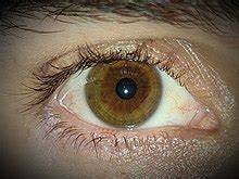 Central Heterochromia Iridis