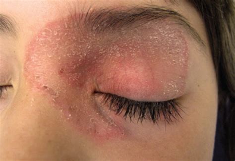 12 Skin Rash On Eyelid Eyelid eyelids rash itchy psoriasis swollen ...