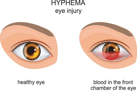 Hyphema: Symptoms, Causes, Diagnosis And Treatment - accuspire