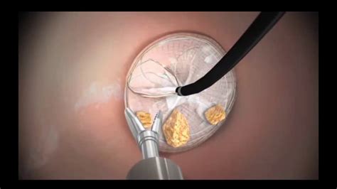 Kidney stone removal surgery 3D animation - YouTube