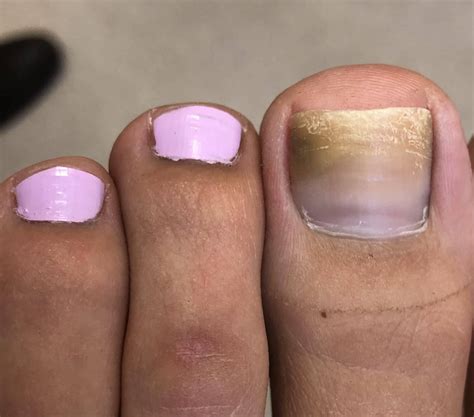 WHY ARE MY TOENAILS SO UGLY? | Healthy Life Foot Clinic