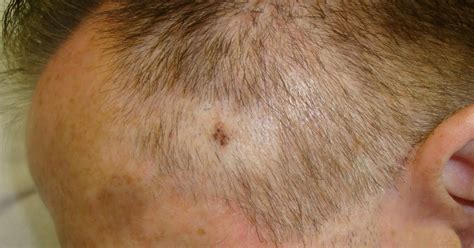 Skin Cancer Bump On Scalp