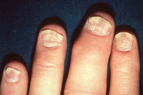 Can Nail Psoriasis Be Cured? 4 Best Nail Psoriasis Treatment Options - Be Your Best, Well, Self