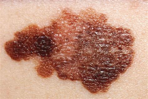 Melanoma | Description, Causes, Symptoms, & Treatment | Britannica