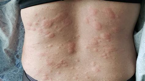 Hives Vs Rash Here S How To Tell The Difference The Healthy - Riset