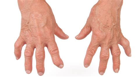 What Causes Hand Deformities in Rheumatoid Arthritis? | DrBadia.com