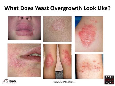 Yeast overgrowth, Candida overgrowth, Yeast infection cure