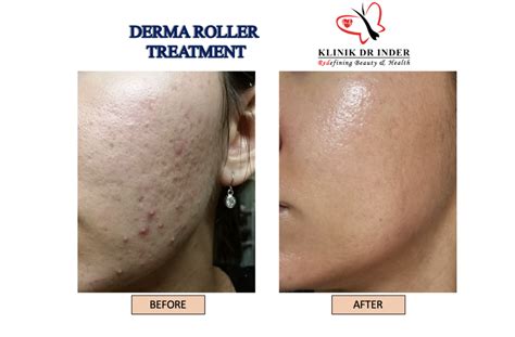 Derma Roller - Skin Treatment - Aesthetic Clinic Malaysia - Klinik Dr Inder