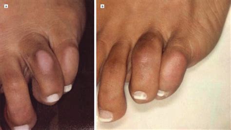 A Novel Treatment for Knuckle Pads With Intralesional Fluorouracil | Dermatology | JAMA ...