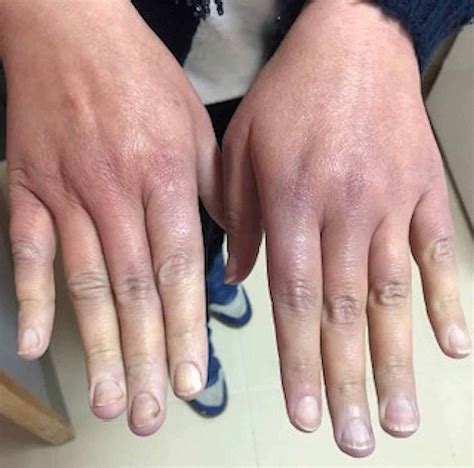 Cureus | Raynaud's Phenomenon: Beware of Cancers!