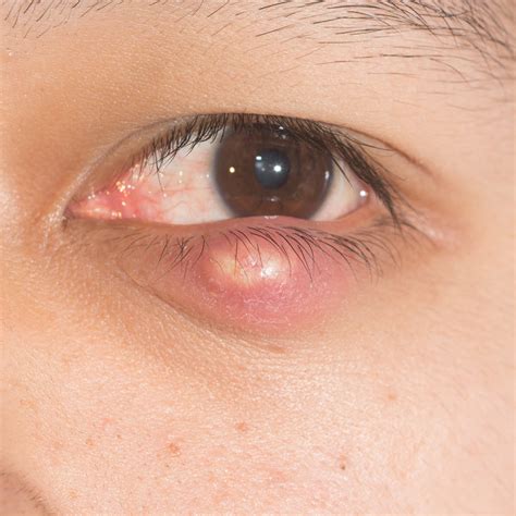 Chalazion Lower Eyelid