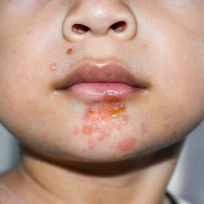 Impetigo - Burnett Dermatology