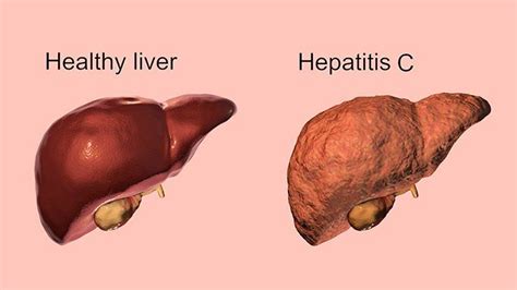 Hepatitis C Liver Disease