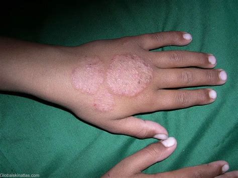 Ringworm vs Eczema: Facts You Need To Know