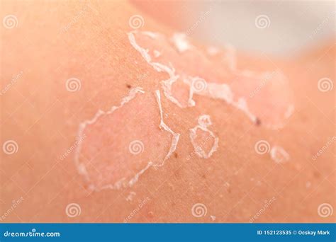 Skin peeling after sunburn stock image. Image of close - 152123535