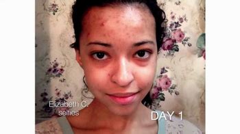 Neutrogena Rapid Clear TV Spot, 'Acne Before & After: Elizabeth's Story ...