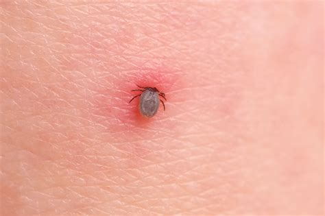 Tick Bite Pictures Symptoms What Does A Tick Bite Look Like? | tunersread.com