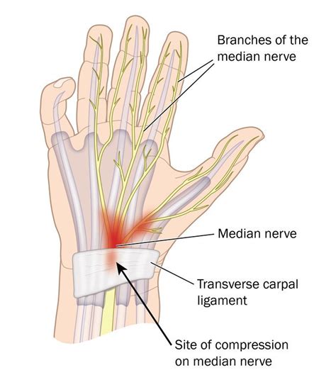 Carpal tunnel syndrome Guide: Causes, Symptoms and Treatment Options