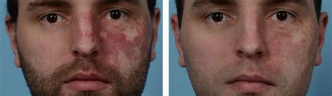 V Beam Laser Rosacea Reddit - The Best Picture Of Beam