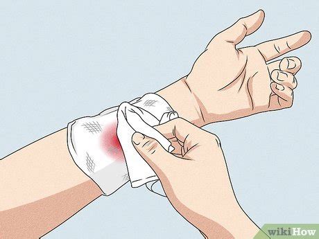 3 Simple Ways to Stop Arterial Bleeding - wikiHow