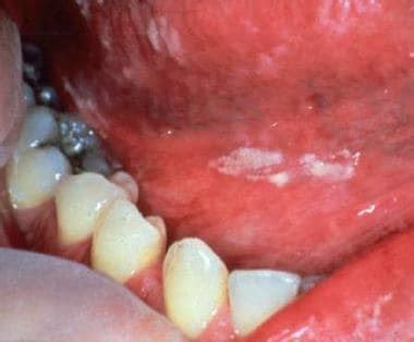 Oral Infection: Overview, Microbiology of Oral Infection, Viral and Fungal Oral Infection