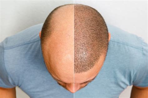 How Much Does a Hair Transplant Cost In LA? - Concord Hair Restoration