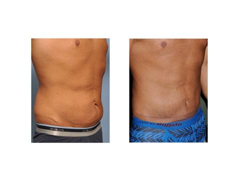 Mini tummy tuck recovery week by week - spanlopez