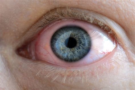 Glaucoma Eye Drops Chart