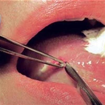 biopsy in oral pathology