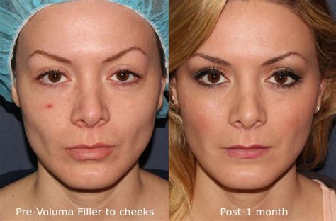 Juvederm vs. Botox: What's the Difference? - Cosmetic Laser Dermatology ...