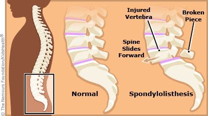 Spondylolisthesis | Dayton Children's Hospital